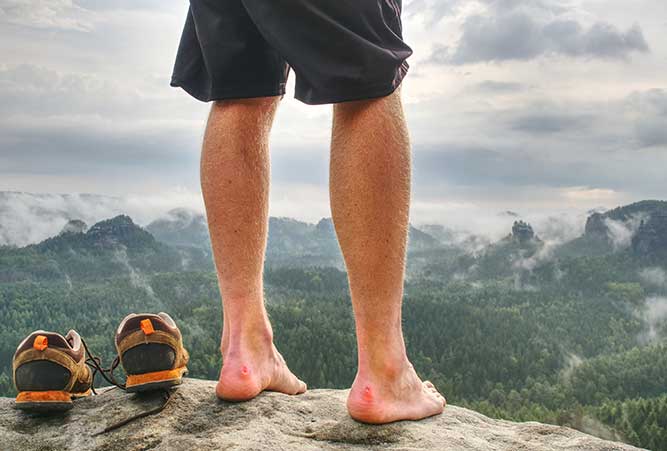 Wanderer mit Blasen an Füßen.